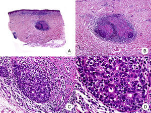 Micosis fungoide siringotrópica. A. Vista panorámica que muestra un infiltrado en banda en dermis reticular y periglandular. B. A mayor aumento se observa la afectación de las glándulas ecrinas por un infiltrado denso de linfocitos. C, D. A mayor aumento se observan linfocitos atípicos rodeando una glándula ecrina con siringometaplasia.