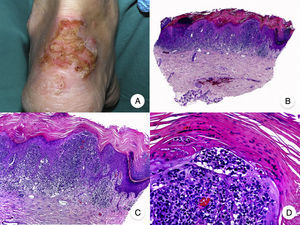 Reticulosis pagetoide. A. Imagen clínica que muestra una placa única, de aspecto psoriasiforme, hiperqueratósica y eritematosa, en el talón. B. Vista panorámica que muestra hiperplasia epidérmica, hiperqueratosis con paraqueratosis y un infiltrado en dermis papilar. C, D. A mayor detalle se puede observar el marcado epidermotropismo del infiltrado, compuesto por linfocitos atípicos de aspecto pagetoide, con un núcleo grande e hipercromático.