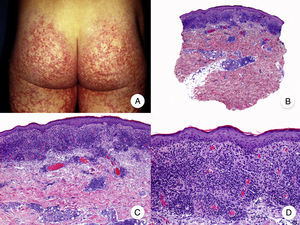 Micosis fungoide poiquilodérmica. A. Imagen clínica que muestra placas con atrofia, hiperpigmentación, hipopigmentación y telangiectasias afectando a ambas nalgas. B. Vista panorámica que muestra un infiltrado de tipo liquenoide en dermis papilar. C, D. A mayor aumento se observa atrofia epidérmica con aplanamiento de la unión dermoepidérmica, infiltrado de linfocitos atípicos con epidermotropismo y dilataciones, y dilataciones vasculares capilares en la dermis superficial.