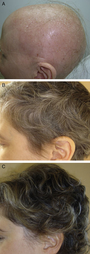 Mujer de 34 años con alopecia areata universal. Repoblación con tratamiento con minipulsos orales de dexametasona a dosis de 0,1mg/kg/d 2 días consecutivos a la semana. A) Basal. B) Mes 4 de tratamiento. C) Mes 8 de tratamiento.