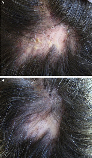 Mujer de 33 años con foliculitis decalvante. Mejoría clínica tras tratamiento con rifampicina 300mg cada 12h asociado a clindamicina 300mg cada 12h durante 10 semanas. A) Basal. B) Al finalizar el tratamiento.