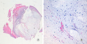 A. Hematoxilina-eosina ×4. B. Hematoxilina-eosina ×40.