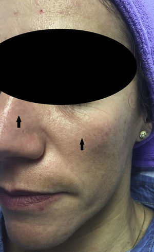 Foto del eritema alcanzado con peeling de glicólico previo a la neutralización con agua con bicarbonato por prurito insoportable por parte de la paciente. En este caso el eritema alcanzado fue tenue como marcan las flechas.