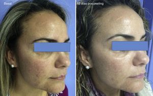 Melasma. Se observa la mejoría en la reducción de la pigmentación y homogenización del tono de la piel a los 10 días de realizar el peeling.