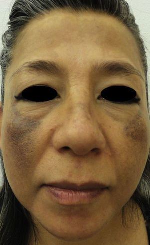 En frente y dorso nasal se observan manchas difusas color marrón oscuro y, en región malar, mejillas máculas puntiformes hiperpigmentadas de color gris oscuro.