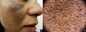 a) Acercamiento de lesiones en mejillas; b) Estudio dermatoscópico: se observa aumento de la seudo-red facial y estructuras intensamente pigmentadas amorfas de color marrón oscuro, que ocluyen aperturas foliculares.