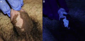 A) Máculas acrómicas localizadas en cuerpo del pene y prepucio; B) La pérdida de pigmento se hace más evidente al emplear la luz de Wood.