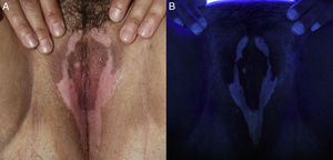 A) Máculas blanco-lechosas distribuidas simétrica y longitudinalmente en labios mayores y periné; B) Con luz de Wood las lesiones se aprecian con mayor intensidad.