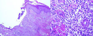 (A) Ulcerated epidermis with a diffuse inflammatory infiltrate in the dermis. (B) Infiltrates formed of neutrophils, histiocytes, lymphocytes, and occasional multinucleated giant cells.