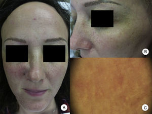 Pápulas faciales en la alopecia frontal fibrosante. A. Se aprecian pápulas foliculares no inflamatorias, monomorfas, color piel, de aspecto rugoso o áspero y sin eritema ni descamación asociados. B. Detalle de las pápulas faciales. C. Con dermatoscopia se aprecian puntos blancos foliculares, sobre la red vascular que se observa habitualmente a nivel facial.