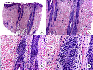Histopatología de la alopecia frontal fibrosante. A y B. En cortes longitudinales se observa infiltrado perifolicular (H-E ×10, H-E ×100, figuras A y B, respectivamente). C y D. A mayor aumento se observa una fibrosis concéntrica perifolicular e infiltrado linfocitario en la periferia (H-E ×200, H-E ×400, figuras C y D, respectivamente).