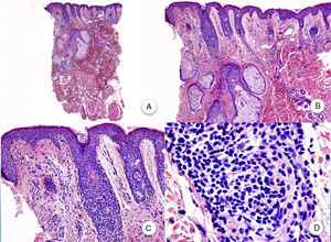 Biopsia una pápula facial. A y B. A bajo aumento se aprecian varios folículos pilosos de tipo velloso con numerosas glándulas sebáceas (H-E ×10, H-E ×100). C y D. Detalle del infiltrado inflamatorio rodeando la porción superior de los folículos pilosos vellosos (H-E ×200, HE ×400).