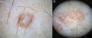 Dermoscopic images of disseminated superficial actinic porokeratosis. (A) Brownish dots and central atrophy visible in patient 3. (B) Patient 4, showing hairpin vessels crossing the lesion.