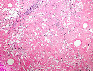 Imagen en «queso suizo», esclerosis difusa de dermis reticular y tejido celular subcutáneo con seudoquistes vacíos.