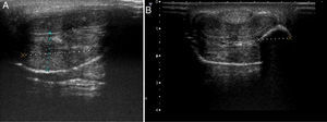 Ecografía de alta resolución realizada con sonda lineal de 14MHz: A) Marcado engrosamiento focal del tejido subcutáneo de la vertiente ventrolateral derecha del pene, con unos diámetros aproximados de 5×2,5cm. Cuerpos cavernosos preservados; B) Lesión seudoquística ovalada con marcada sombra acústica posterior.