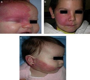 Distribución de la mancha en vino de Oporto; a) rama frontal (V1); b) rama maxilar (V2); c) rama mandibular (V3).