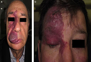 a) Mancha en vino de Oporto con hipertrofia de tejidos blandos; b) mancha en vino de Oporto con formación de nódulos proliferativos.