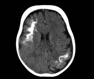 TC craneal sin contraste. Corte axial centrado a la altura de los ventrículos laterales, demostrando múltiples calcificaciones en ambos hemisferios cerebrales con un patrón curvilíneo y giriforme, asociado a pérdida de volumen cerebral en estas mismas localizaciones.