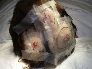 Nódulos eritematosos que afectan de modo multifocal al cuero cabelludo.