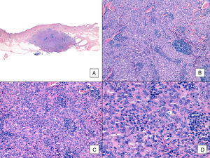 Angiosarcoma con predominio de patrón sólido. A. En la imagen panorámica el tumor infiltra la dermis reticular media y profunda y la hipodermis (hematoxilina-eosina ×10). B. El tumor es densamente celular, destruye las estructuras preexistentes y se acompaña de nódulos de infiltrado linfocitario (hematoxilina-eosina ×100). C y D. En el detalle se aprecia un predominio de células epitelioides acompañadas de infiltrado linfocitario (hematoxilina-eosina ×200 y ×400, respectivamente).