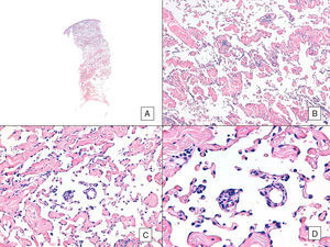 Angiosarcoma con predominio de patrón vasoformativo. A. En la imagen panorámica se aprecia infiltración de toda la dermis hasta la hipodermis (hematoxilina-eosina ×10). B. Las luces vasculares neoplásicas disecan el colágeno masivamente(hematoxilina-eosina ×100). C y D. Los vasos no neoplásicos son disecados por los endotelios neoplásicos, de modo que quedan «flotando» en la dermis (signo del promontorio) (hematoxilina-eosina ×200 y ×400, respectivamente).