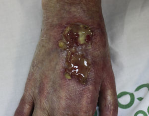 Úlcera de 9 meses de evolución en el dorso de la mano derecha de 6×3cm de diámetro, limpia y con la base sanguinolenta.
