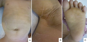 (A) Generalized xerosis with fine desquamation on the trunk. (B) Hyperkeratotic and brownish skin on the armpits. (C) Hyperkeratotic skin on the soles.