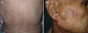 A. Pápulas excoriadas en la espalda. B. Pápulas eritematosas distribuidas de forma lineal.