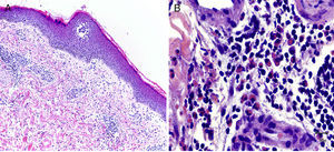A. Hematoxilina-eosina (×50). Epidermis con discreta espongiosis. En la dermis superficial se aprecia un infiltrado inflamatorio mixto de predominio perivascular y perianexial. B. Hematoxilina-eosina (×400). Infiltrado inflamatorio en la dermis profunda con la presencia de gran número de eosinófilos.