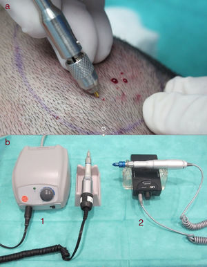 Sistemas de FUE. a. Punch de uso manual. Para extraer la UF hay que alinear el punch con el ángulo y dirección de salida del pelo, y este debe quedar en el centro del punch. b. Algunos sistemas motorizados: aparato SAFE de Harris (HSCDevelopment, Colorado, EE. UU.) (1) y aparato Vortex de Cole (Cole Instruments, Georgia, EE. UU.) (2).