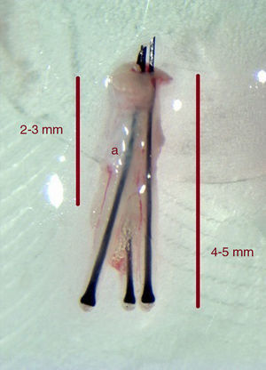 Los punches de punta afilada se deben introducir solo 2-3mm en profundidad para reducir el riesgo de transección de los folículos. Los punch romos e híbridos se pueden introducir a mayor profundidad (>4mm).(a): Glándula sebácea.