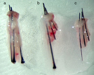 Unidades foliculares. (a): Normal y sin daño; (b): con transección parcial de 2 folículos; (c): con transección total de la unidad folicular.