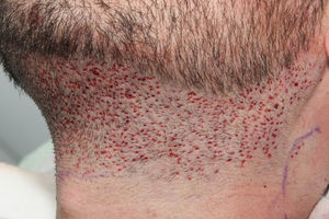 Barba como zona donante; 1.100 extracciones realizadas con punch afilado de Cole de 0,9mm en sistema motorizado Vortex® (Cole Instruments, Georgia, EE. UU.).