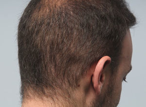 Zona donante hipodensa de aspecto «apolillado» por exceso de extracciones.