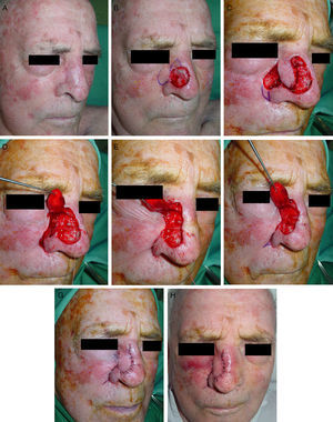 A. Paciente remitido para cirugía de Mohs por carcinoma basocelular en el lateral nasal, extirpado previamente con borde profundo y laterales afectos, y reconstruido con un colgajo de trasposición de la piel adyacente. B. Defecto final y diseño de un colgajo de trasposición de la piel de la mejilla que descansa sobre el inicio del surco nasolabial. C. Colgajo disecado en el plano subcutáneo, desplazado para cubrir el defecto. Dibujo de un pequeño triángulo de Burow con el vértice hacia el surco nasogeniano. Se aprecia una desproporción entre el tamaño del colgajo y el área cruenta. D y E. Maniobra de la aproximación de los tejidos con una sutura en «cuerda de guitarra» que reduce el tamaño del defecto. F. Finalmente se utiliza otra sutura un poco más inferior, que facilita que el tejido desplazado ensamble sin tensión en el nuevo lecho. G. Resultado inmediato tras la sutura con seda de 6/0. H. Aspecto a las 24horas.