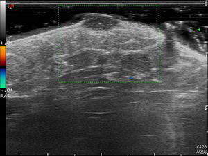 Imagen de ecografía doppler de alta frecuencia (18mHz) en la que se observa una lesión bien delimitada, homogénea, hipoecoica localizada en la dermis de 6,5×3,5mm sin flujo en su interior.
