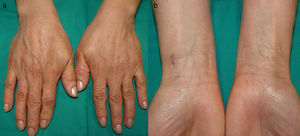 Pigmentación moteada marrón lentiginosa en el dorso de ambas manos (a) y la cara anterior de las muñecas (b).