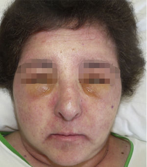 Erupción eritematoviolácea facial con marcado edema facial y cervical, siendo muy llamativo a nivel palpebral bilateral y simétrico.