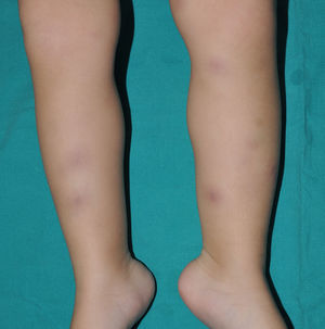 Síndrome de Blau. Nódulos eritematovioláceos en ambas zonas pretibiales muy similares a la presentación clínica del eritema nudoso.