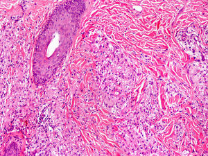 Síndrome de Blau. Granulomas no caseificantes con histiocitos, linfocitos, eosinófilos y células gigantes multinucleadas (H/E ×20).