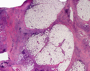 Síndrome H. Importante fibrosis de la dermis y el tejido celular subcutáneo, más intensa en el subcutis, que ocasiona una obliteración progresiva del tejido graso (H/E ×20).