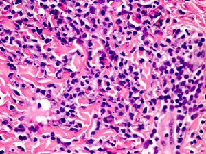 CANDLE. Infiltrado de células mieloides mononucleares atípicas de núcleos grandes y abigarrados con citoplasma eosinófilo escaso, acompañado de neutrófilos y eosinófilos (H/E ×40).