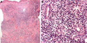 Infiltrado linfocitario perivascular, instersticial y perianexial que alcanza la hipodermis y respeta la epidermis, constituido por linfocitos de talla pequeña o mediana y pleomorfismo leve-moderado. A. Hematoxilina-eosina ×10. B. Hematoxilina-eosina ×40.