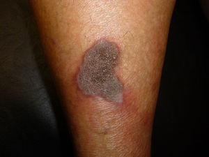 Placa espongiforme pretibial con halo violáceo.
