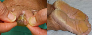 (a) Placa hiperqueratósica interdigital. (b) Queratodermia difusa plantar.
