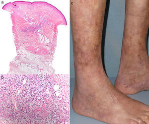 (a) Epidermis normal, con lesiones centradas en la dermis y el tejido celular subcutáneo (hematoxilina-eosina, ×4). (b) Necrosis fibrinoide e infiltrado neutrofílico en los vasos de mediano calibre acompañado de infiltrado eosinofílico (hematoxilina-eosina, ×20). (c) Livedo residual en las piernas, tras inicio de tratamiento con infliximab.