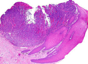Histología. Melanoma almelanótico ulcerado Bres-low 3 mm.