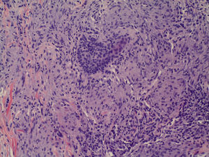 H-E×20. Granuloma de tipo sarcoideo en la dermis.