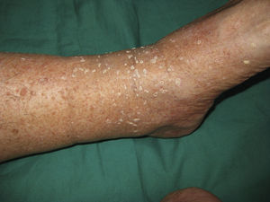 Hyperkeratotic lesion on the legs.