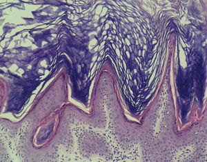 Hemanotoxylin-eosin (×100). Orthokeratotic papillomatosis with focal lymphoid infiltrate in papillary dermis and church spire pattern.